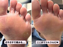 ココネイル(coco.nail)/足裏のガサガサをツルスベ肌へ