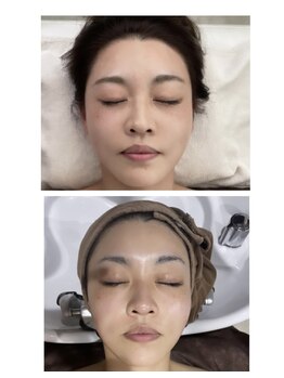 ミエリフル(Miel et Fleurs)/WINBACKヘッドスパBefore→After