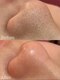 カラット ベル店(KARAT)の写真/あなたの鼻の頑固な黒ずみ、お任せください！KARAT式最強毛穴洗浄で、見違えるように毛穴ごっそりお掃除♪