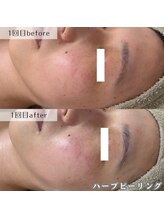 ネイルズビー 別邸(Nail's be)/ハーブピーリング1回の効果