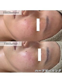 ネイルズビー 別邸(Nail's be)/ハーブピーリング1回の効果