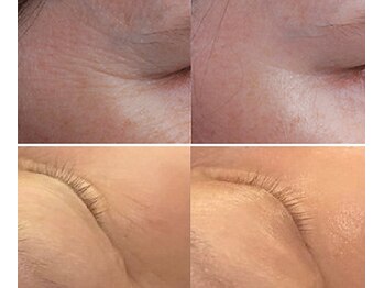ナチュレアンドメディカ(Nature&Medica)/顔脱毛+小じわケアフェイシャル
