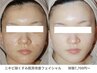 肌質改善人気NO.1゛韓国゛肌管理【毛穴/潤ツヤ/発光肌】水光ピーリング
