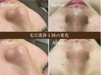 サロン アイプラス(salon i plus)の写真/毛穴の黒ずみ・詰まり・ざらつきを優しくケア。触りたくなるような"つるんと肌"にその場で実感