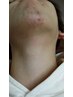 【メンズ脱毛★口の周り】鼻下、あご、あご下、もみ上げ　14300円→3850円