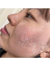 リベル 名古屋(Lebelle:)/ハーブピーリング名古屋リベル