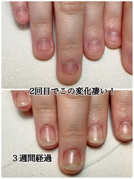 スマイルニコ(smile nico)/深爪でも大丈夫