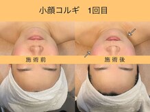 オプレア 栄店(OPREA)/比較写真【小顔コルギ】