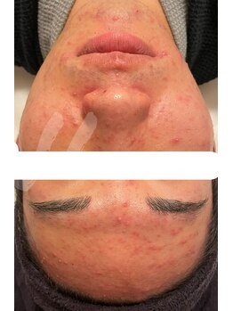 エステサロン ジジ 新宿(JIJI)/メンズ ハーバル レベル1を1回