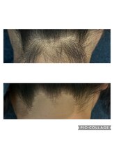 ソイ(soi)/うなじ脱毛