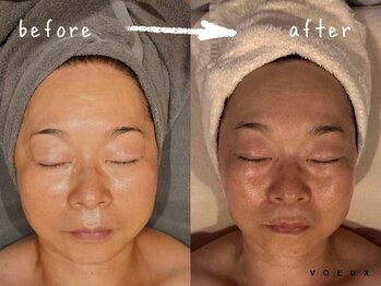 ボウ 静岡本店(VOEUX)/小顔・たるみ 6回