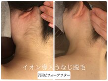 リノ(Lino)/うなじ脱毛シェービング付き♪