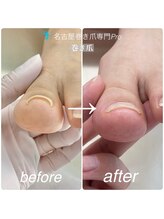 巻き爪補正3回目の変化