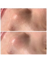 ティアーナ(Tiaana)/毛穴洗浄