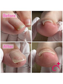 Dr.巻き爪 札幌北一条東院/40代女性!痛みが少なくなり感動