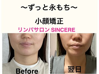シンシア(SINCERE)/～ずっと永もち～小顔矯正