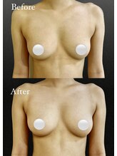 アンシャンテ(ENCHANTER)/光バストアップ