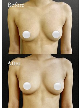 アンシャンテ(ENCHANTER)/光バストアップ