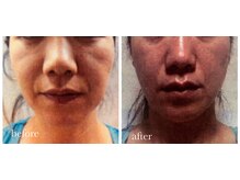 サロン ド ラム/【光フェイシャル】4回目