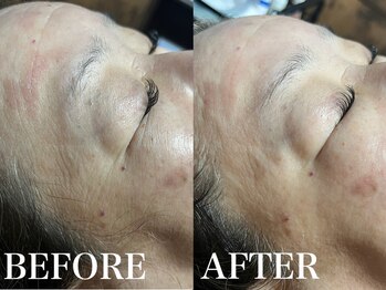 エルミオ エスパシオ ミロク(El mio espacio 369miroku)/カーボキシーパック～お顔編～