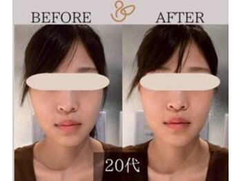 チョコバリ 新宿店(chocobari)/小顔×リフトアップ(美容鍼)20代