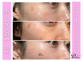 プルクレ 常磐町店(Pulchre)/おうちでしみケアプログラム♪