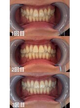 スマイルプライベートビューティサロン(Smile)/セルフホワイトニング