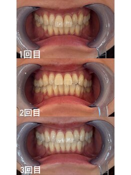スマイルプライベートビューティサロン(Smile)/セルフホワイトニング