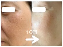 Private salon one-shotの雰囲気（くすみ、たるみ、しみもあら不思議、透明感あふれる肌に♪）