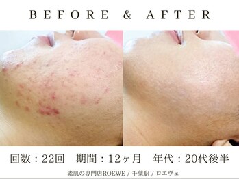 ロエヴェ(ROEWE)/ニキビ改善・毛穴ケア・肌質改善