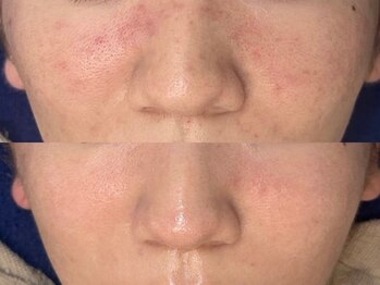 ロイ 初生店(LOI)/ハーブ×プラズマ