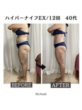 リヘッド(Re.head)/ハイパーナイフでむくみスッキリ