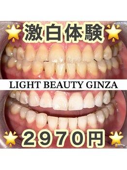 ライトビューティー 銀座店(LightBeauty)/東銀座 ホワイトニング症例写真