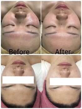 アミリー(A'mily)/[国産]剥けないハーブピーリング