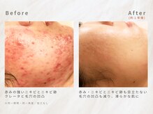 メレ(mele)/20代ニキビケア／毛穴