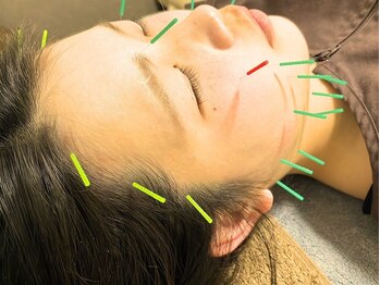 けん鍼きゅう整骨院/【美容鍼】