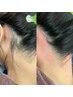 【女性】夏に向けてうなじワックス+光脱毛6,500円→5,500円