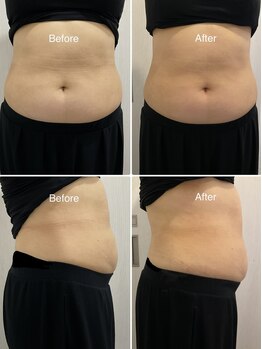 セラス(CERAS)/フォースカッター &nbsp;お腹30分