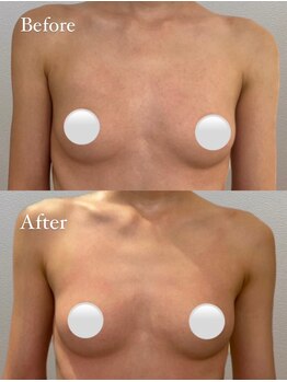 アンシャンテ(ENCHANTER)/光バストアップ