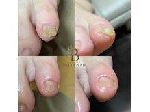 ベルタネイル(BELTA NAIL)