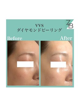 ザラハビューティー(ZARAHA Beauty)/VVSダイヤモンドピーリング