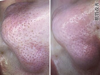 5つ星/◆ハイドロ毛穴洗浄