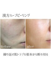 モイ(moi.)/◆漢方ハーブピーリング◆