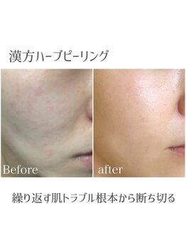 モイ(moi.)/◆漢方ハーブピーリング◆