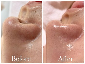 ヌー 栄(nuu)/ハイドラフェイシャル