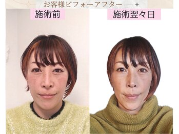 プランドール/小顔になりお鼻も変化しました♪