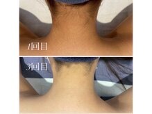 オーシャンブルー 佐世保店(OCEAN BLUE)/スピード卒業脱毛