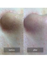 んまち/韓国式3D毛穴洗浄