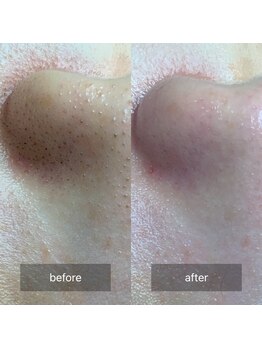 んまち/韓国式3D毛穴洗浄