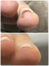 シュガーズネイル(sugar's nail)/巻き爪ケア